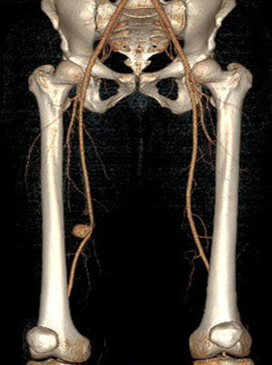 Imagen de angio-TC de seudoaneurisma en arteria femoral superficial derecha.