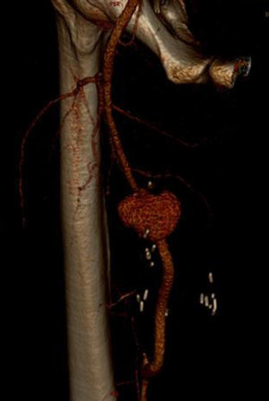 Imagen de angio-TC de seudoaneurisma en anastomosis proximal de bypass femoropoplíteo derecho.