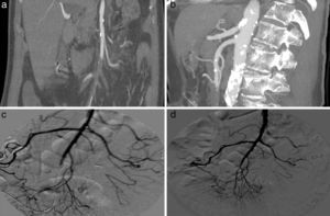 Angio-TC: oclusión en rama yeyuno ileal de arteria mesentérica superior (a y b). Arteriografía diagnóstica (c) y control postratamiento (d).