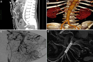 Angio-TC: oclusión de la arteria mesentérica superior (a y b). Arteriografía durante colocación de stent (c). Angio-TC de control al año (d).