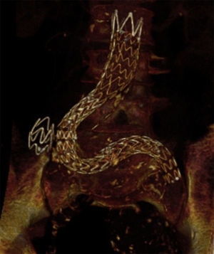 Endoprótesis aortouniiliaca izquierda y oclusor iliaco derecho.