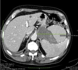 Corte transversal abdominal: aneurisma de arteria esplénica de 13,7cm