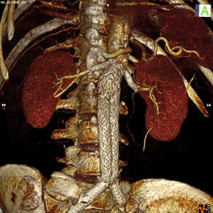 Angio-TC de control a las 72 h. Se observa permeabilidad tanto de las chimeneas renales como del resto de arterias viscerales, sin observarse endofugas ni desplazamiento de prótesis.