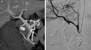 a) Reconstrucción de angio-TC: seudoaneurisma en arteria gastroduodenal. b) Angiografía de control postembolización sin observarse fugas.