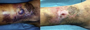 A la izquierda se observa la tumoración violácea y los cambios tróficos antes del tratamiento endovascular. La fotografía de la derecha muestra el aspecto de las lesiones cutáneas un mes después de la embolización de la MAV.