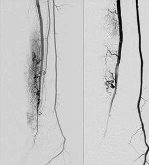 A la izquierda se observa la imagen arteriográfica que muestra la arteria tibial anterior derecha hipertrofiada dando ramas que se dirigen al nidus de la MAV. A la derecha se observa la imagen arteriográfica tras la embolización parcial con etilenvinilalcohol.