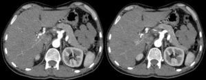 Dilatación fusiforme del tronco celíaco, disección de arteria esplénica y hepática (con trombosis parcial de la luz falsa).