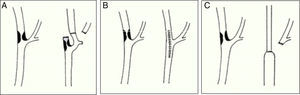 Primeras técnicas quirúrgicas para solventar una estenosis de la carótida interna. A) Carrea, Molins y Murphy (Buenos Aires, 1951); B) De Bakey (Houston, 1953); C) Eastcott, Pickering y Rob (Londres, 1954).