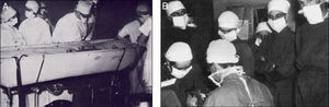 Fotos cedidas por el Dr. HHG Eastcott, con motivo de su homenaje, realizado por la Universidad de Salamanca (2001). A) Baño de hipotermia previo a la cirugía; B) Fotos intraoperatorias (de espaldas el Prof. Rob, de frente el Dr. Eastcott).