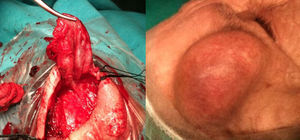Derecha: Seudoaneurisma de rama frontal de la arteria temporal de 4cm de diámetro máximo. Izquierda: Cápsula del seudoaneurisma resecada. Ligadura en arteria frontal proximal y distal al seudoaneurisma (caso clínico 1).