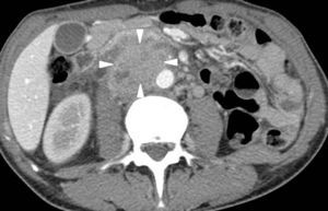 Abdominal CT scan, axial view: large retroperitoneal solid mass (white arrowheads), heterogeneously enhanced after contrast injection, with large contact with aorta and no visualization of the inferior vena cava.