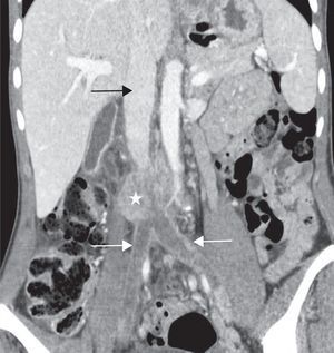 Abdominal CT scan, frontal view: heterogeneous mass (white star) centered on the inferior under renal vena cava causing iliac veins thrombosis (white arrows) which are no more filled with contrast. Above renal inferior vena cava (black arrows).