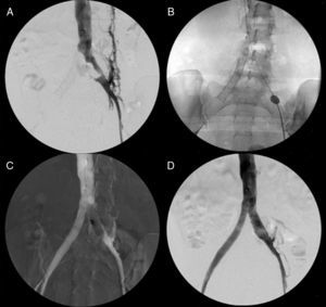 A) Trombosis venosa iliocava. B) Trombectomía venosa. C) Angioplastia venosa ilíaca izquierda tras resección de mioma. D) Control final.