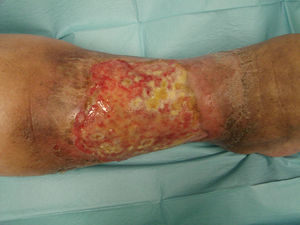 Úlcera de gran extensión y muy dolorosa en cara externa de pierna derecha.