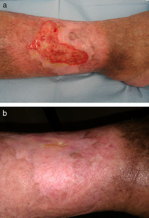 a) Reducción a la mitad de tamaño a los 3 meses de iniciado el tratamiento con Bosentán. b) Cicatrización de la úlcera a los 6 meses de tratamiento con Bosentán.