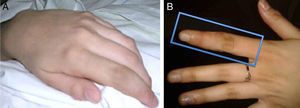 A)Imagen macroscópica de la MVP en el 2.° dedo de la extremidad superior izquierda. B)Imagen macroscópica de la MVP posterior al procedimiento.