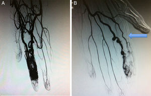 A)Imagen arteriográfica diagnóstica de MVP en el 2.° dedo de la extremidad superior izquierda. B)Imagen arteriográfica posterior a la primera inyección de tratamiento. La flecha indica el catéter vertebral.