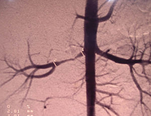 La angiografía muestra lesión de la arteria renal derecha.