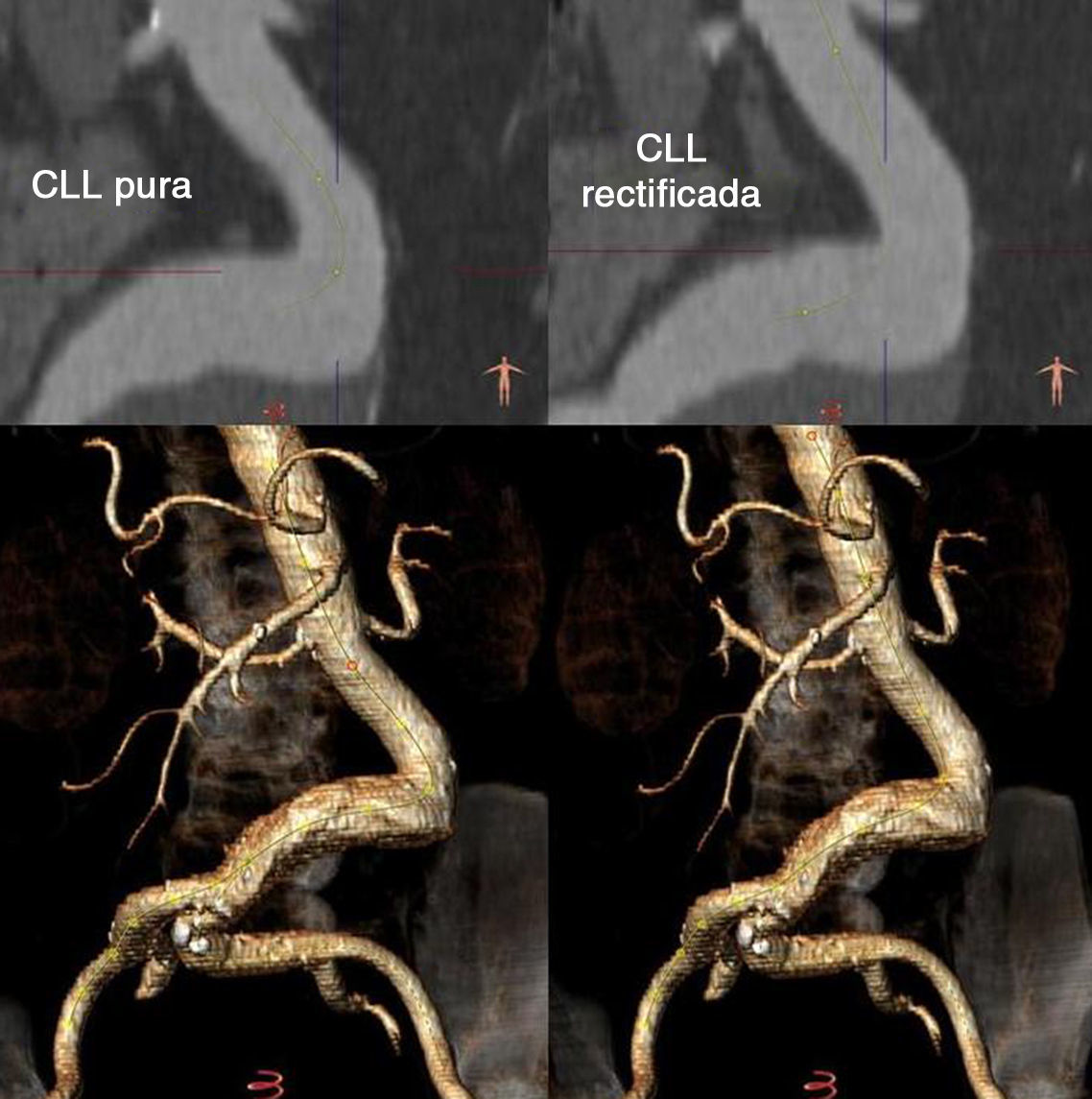 Diferencias entre la planificación del tratamiento endovascular de ...