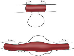 Dispositivo stent-prótesis, en los aneurismas de morfología sacular (parte superior) y fusiforme (parte inferior).