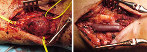 Imágenes intraoperatorias del seudoaneurisma y bypass con vena cefálica invertida tras la resección del mismo.