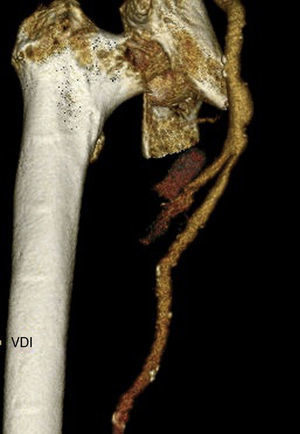 Reconstrucción volumétrica de la zona de rotura del aneurisma de la arteria femoral profunda.