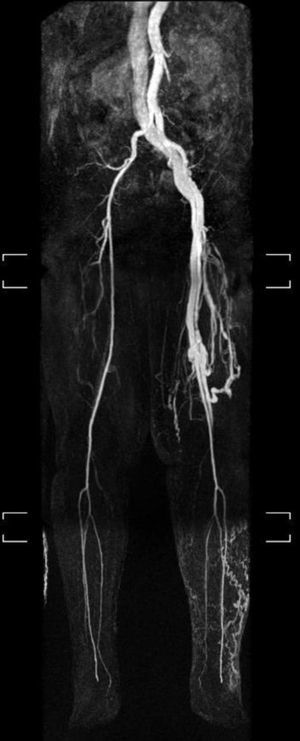 Angio-RMN con pseudoaneurisma y fístula arteriovenosa en arteria femoral superficial en miembro inferior izquierdo.