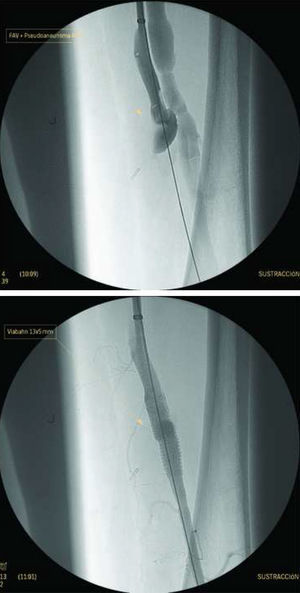 Arteriografía con pseudoaneurisma y fístula en arteria femoral superficial, antes y después de la implantación de stent recubierto (Viabahn® 13×50mm).