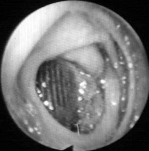 Imagen endoscópica de prótesis aórtica a través de erosión de la pared duodenal (FAE secundaria).