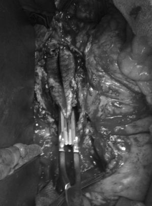 Imagen quirúrgica de rotura de línea de sutura de anastomosis proximal de prótesis aórtica con relación a FAE.