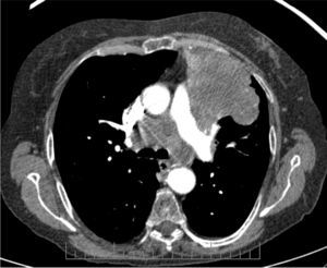 Neoplasia de pulmón en lóbulo superior izquierdo.