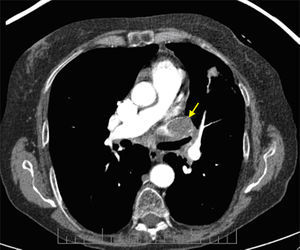 Defecto de repleción en vena pulmonar izquierda (trombo tumoral).