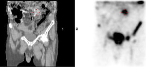 Gammagrafía con leucocitos marcados preoperatoria, que muestra infección de la prótesis vascular a nivel L2-L3.