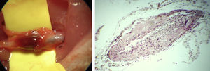 Arteria carótida trombosada tras 15 días, imagen macroscópica (izquierda), y corte histológico a 400x (derecha) (hematoxilina eosina).