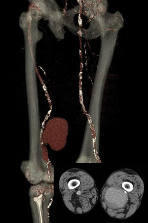Angio-TC: aneurisma poplíteo roto con pseudoaneurisma asociado de 9-10cm de diámetro máximo contenido en la cara interna-posterior del muslo.