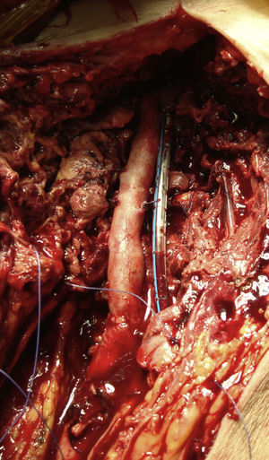 Autoinjerto con vena femoral superficial ipsilateral. Interposición desde la arteria ilíaca externa distal hasta la bifurcación de la arterial femoral común.