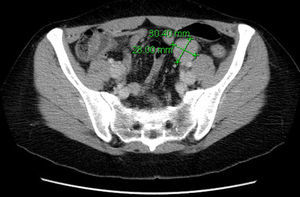 Tomografía computarizada con tumoración redondeada en pelvis menor.