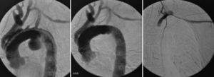 Caso 2. Arteriografía intraoperatoria: A) Permeabilidad de los injertos realizados en un primer tiempo quirúrgico y visualización de aneurisma sacular. B) Control tras la implantación de endoprótesis C-TAG (Gore®). C) Amplatzer en origen de subclavia izquierda, ausencia de relleno del cayado desde inyección humeral izquierda.