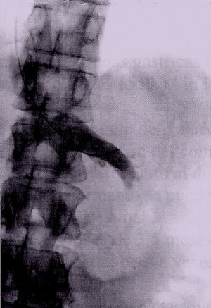 Válvula en vena renal izquierda, a 1,5cm de la desembocadura en la vena cava inferior. Nota: La válvula impide el paso de la guía.