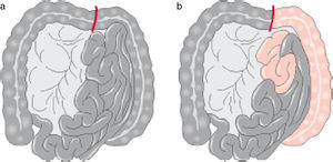 Isquemia aguda con necrosis intestinal. a) Intestino totalmente afectado, indica trombosis arterial. b) Isquemia intestinal con yeyuno y colon izquierdo viable, indica embolia de la arteria mesentérica superior1.