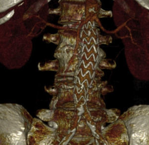 Endoprótesis mediante 2 ramas ilíacas superpuestas (tipo Endurant®) en aorta abdominal infrarrenal.
