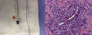 Imagen macroscópica y detalle microscópico del tumor glómico.