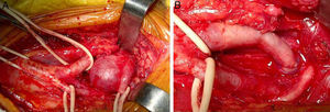 A) Cirugía: disección. B) Resección y anastomosis.