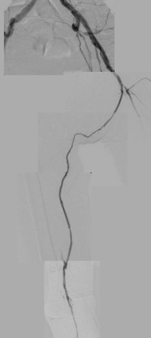 Angiografía de control: bypass con vena safena invertida desde la arteria femoral común izquierda, tunelizado por vía transperineal-infraescrotal hasta la primera porción de la arteria poplítea derecha.