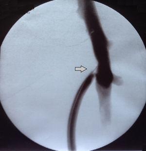 Estenosis de la anastomosis entre vena femoral y PTFE de 6mm.