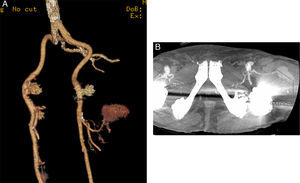 A y B) Angio-TC: pseudoaneurisma dependiente de la arteria circunfleja femoral lateral de 4cm de diámetro.