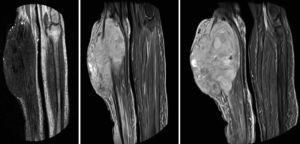 RMN de ambas piernas, donde se visualizó tumoración en cara anterolateral de la pierna derecha con afectación cutánea, del tejido celular subcutáneo y de los 3 compartimentos musculares de la pierna en profundidad.