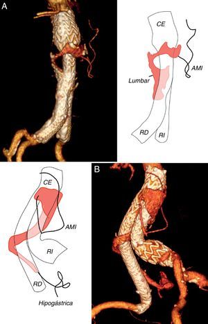 Reconstrucción tridimensional de angiotomografía computarizada en dos casos de endofuga compleja, por arteria mesentérica inferior (AMI) y una arteria lumbar A) y por AMI y arteria hipogástrica derecha B). CE: cuerpo de la endoprótesis; RD: rama derecha de la endoprótesis; RI: rama izquierda de la endoprótesis.