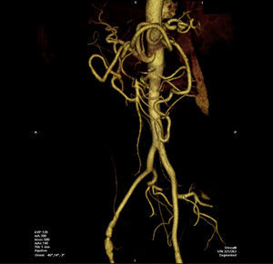Trombosis de arteria mesentérica superior (flecha) en paciente asintomático con gran arcada de Riolano.