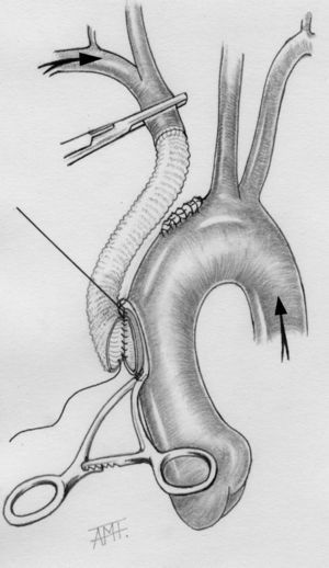 Técnica quirúrgica: injerto aorto-arteria innominada. Las flechas indican el flujo arterial hacia los troncos supraórticos durante el procedimiento.